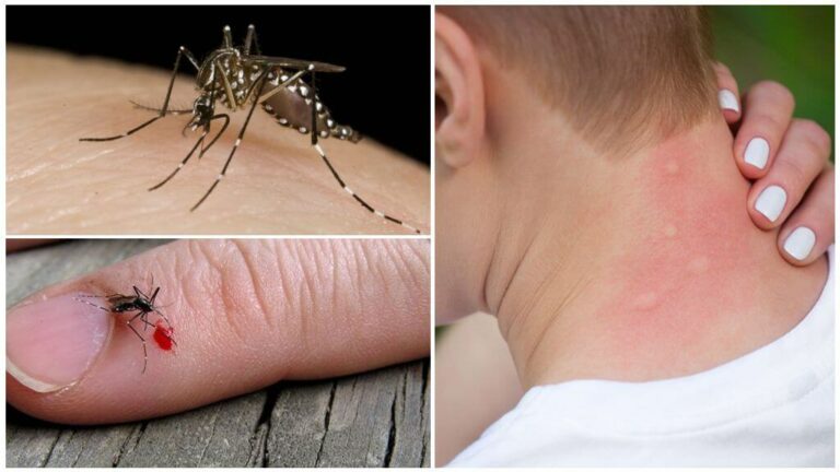 Pourquoi certaines personnes se font-elles plus piquer que d'autres par les moustiques ?